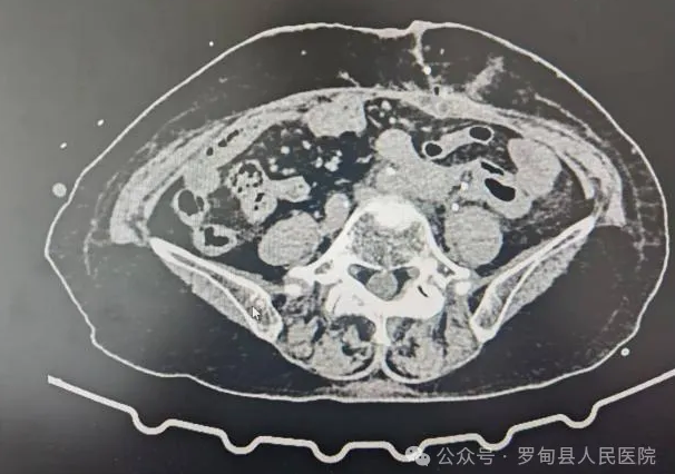 【技术突破与提升】我院外一科成功完成腹膜后巨大肿瘤联合脏器切除高难度手术